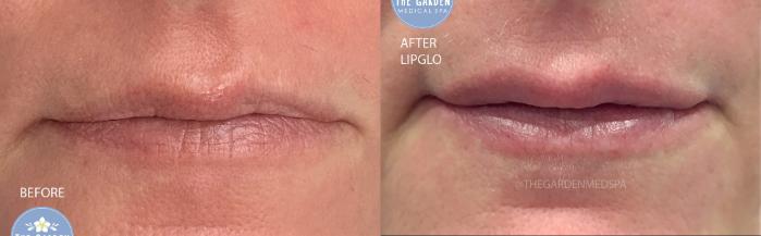 LipGlo for Thin Lips
