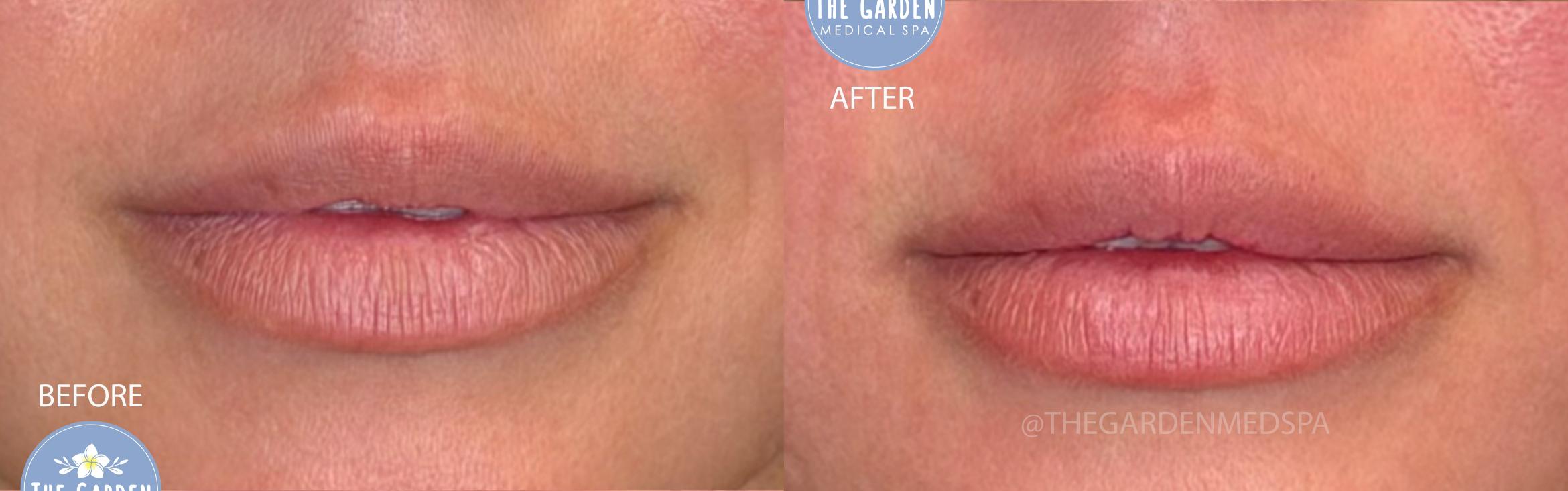 LipGlo with Lip Filler