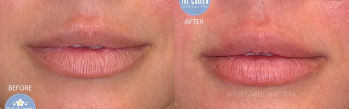 LipGlo with Lip Filler