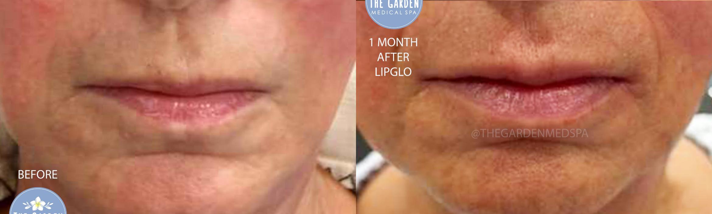 1 Month After LipGlo