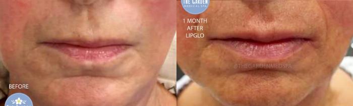 1 Month After LipGlo