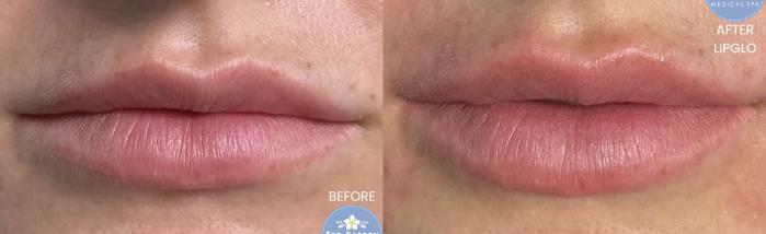 LipGlo