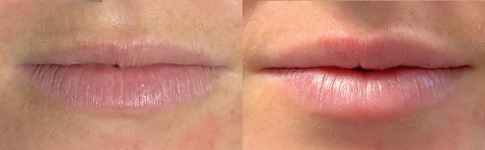 LipGlo for Smoothness