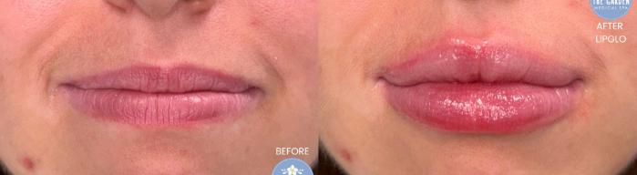 No Filler, Just LipGlo