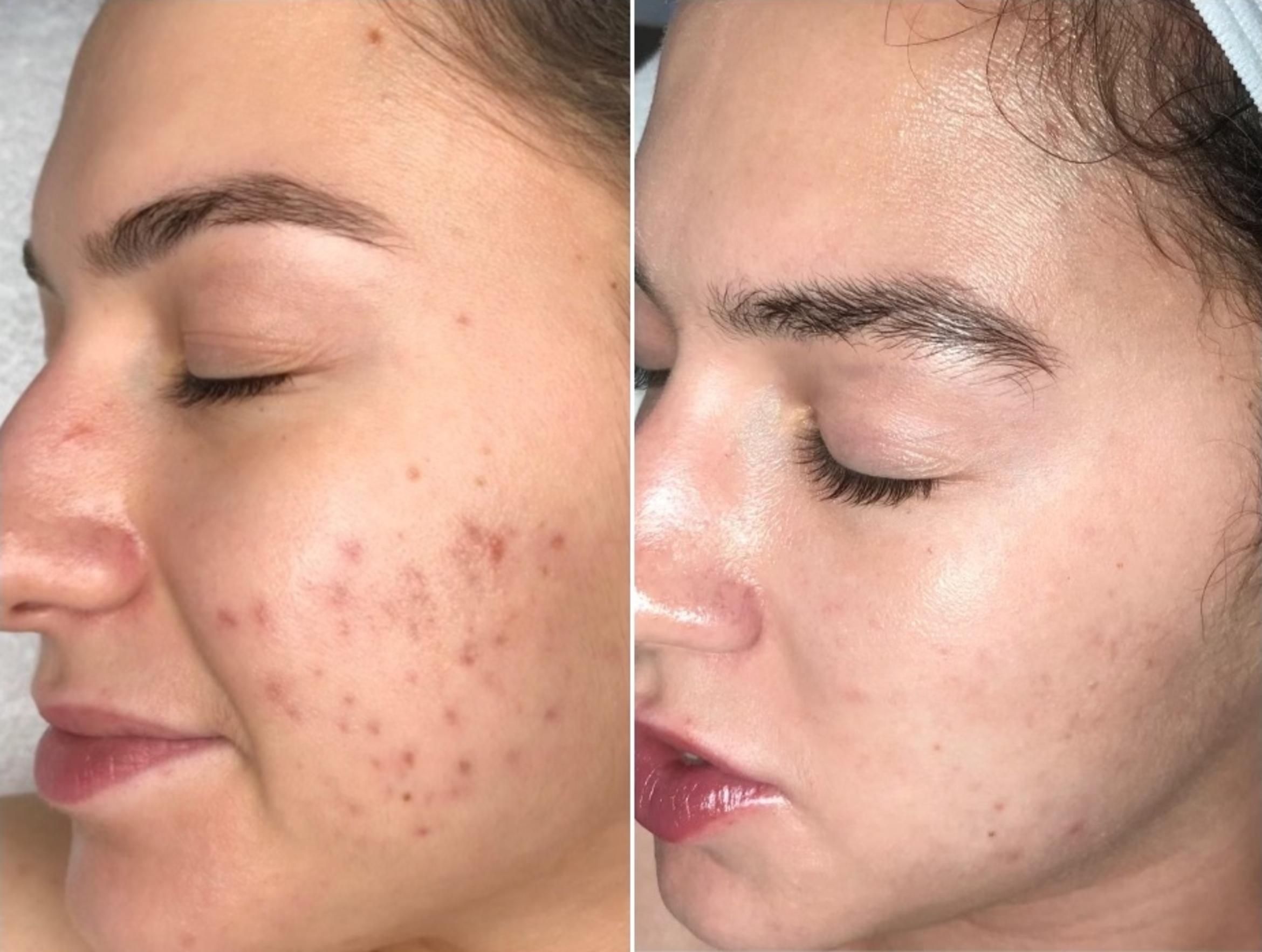 Before & After Microneedling Client #12 Left Side View in Tampa Bay, North Palm Beach, FL