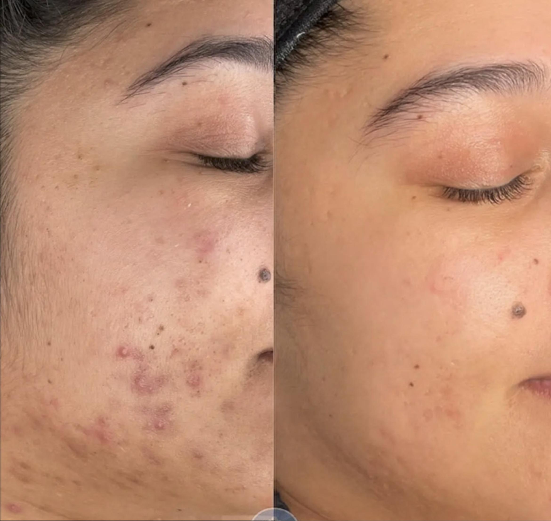 Microneedling for Acne & Scars