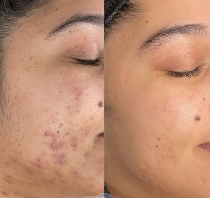 Microneedling for Acne & Scars