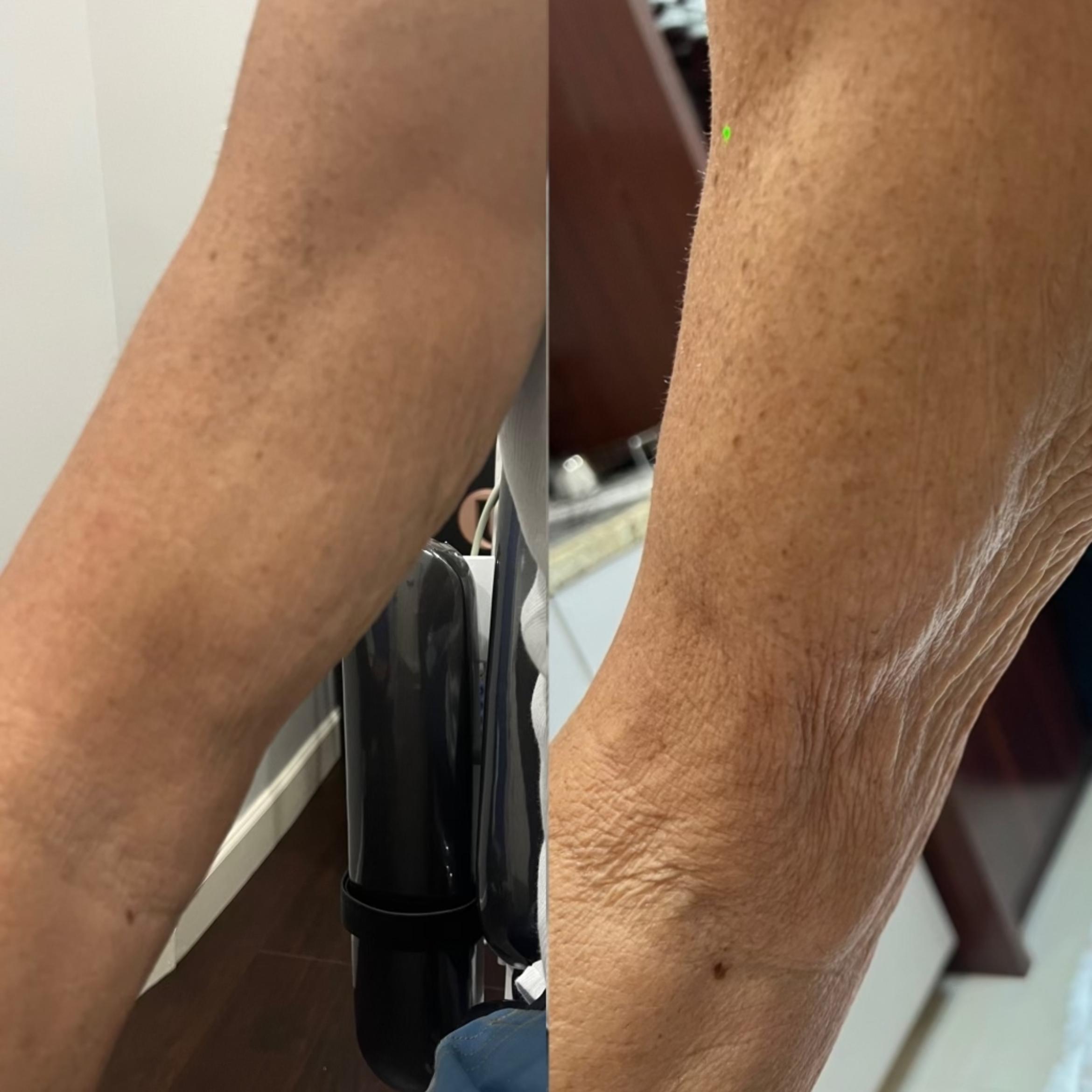 Before & After Microneedling Client #62 Front View in Tampa Bay, North Palm Beach, FL