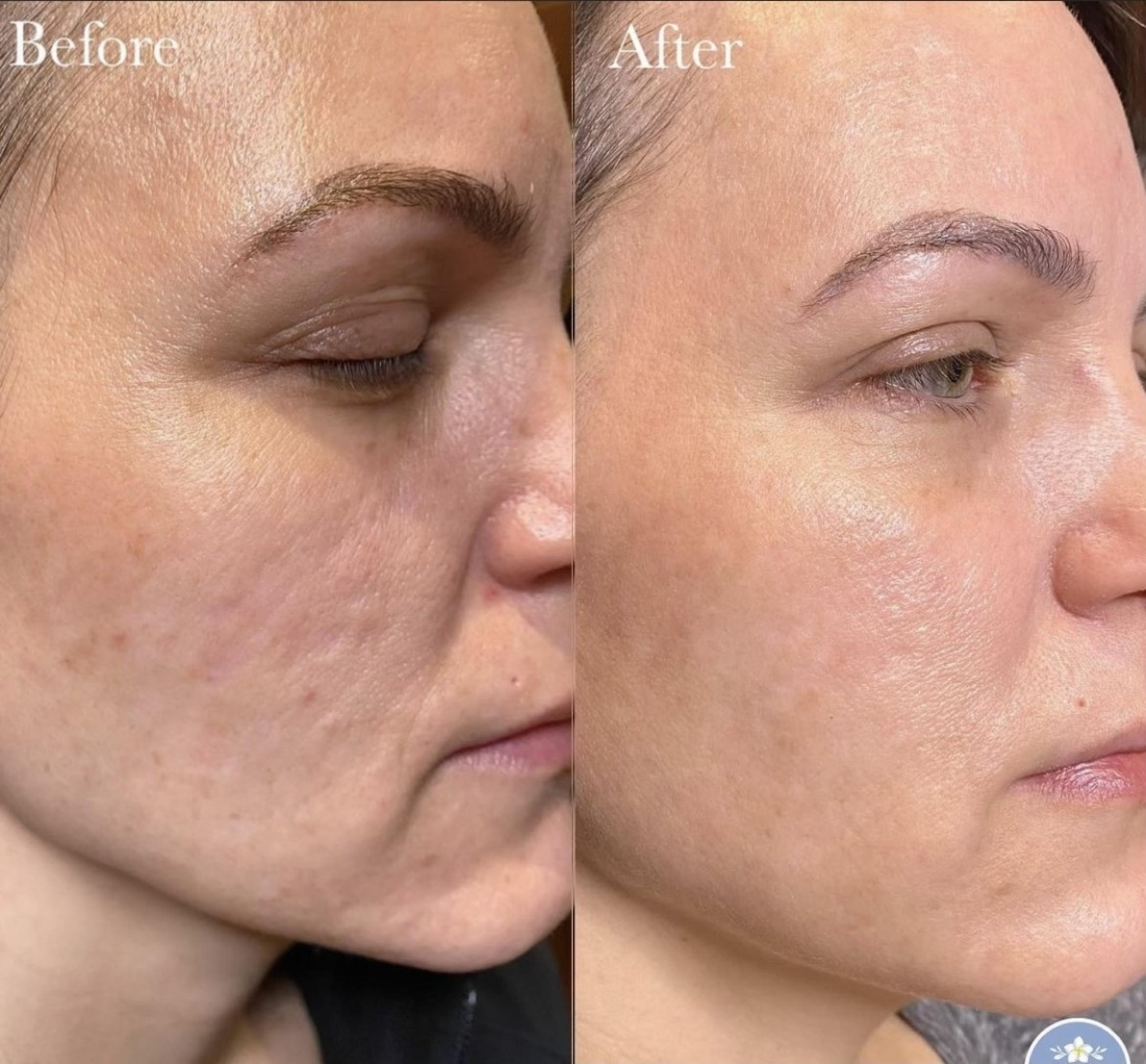 Before & After Microneedling Client #71 Right Side View in Tampa Bay, North Palm Beach, FL