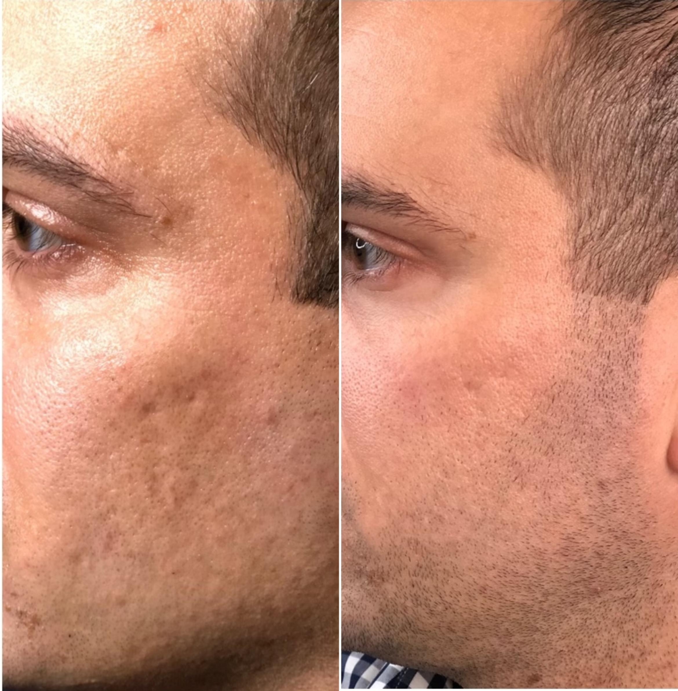 Before & After Microneedling Client #81 Left Side View in Tampa Bay, North Palm Beach, FL