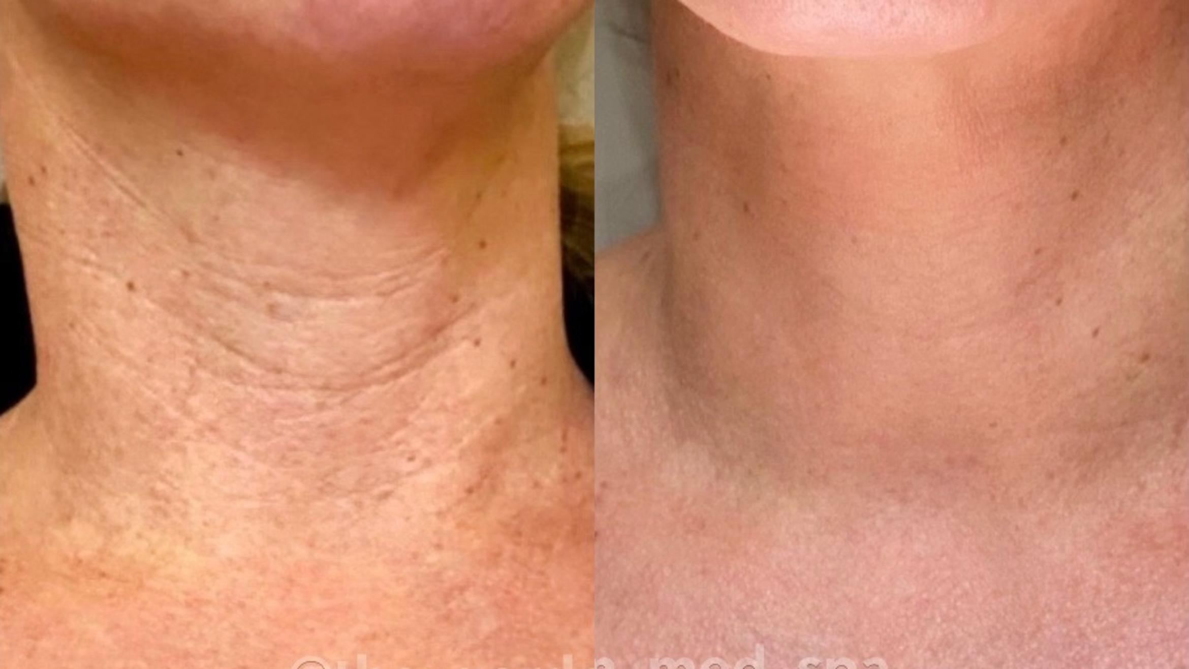 Before & After Radiofrequency Skin Tightening Client #1 Front View in Tampa Bay, North Palm Beach, FL