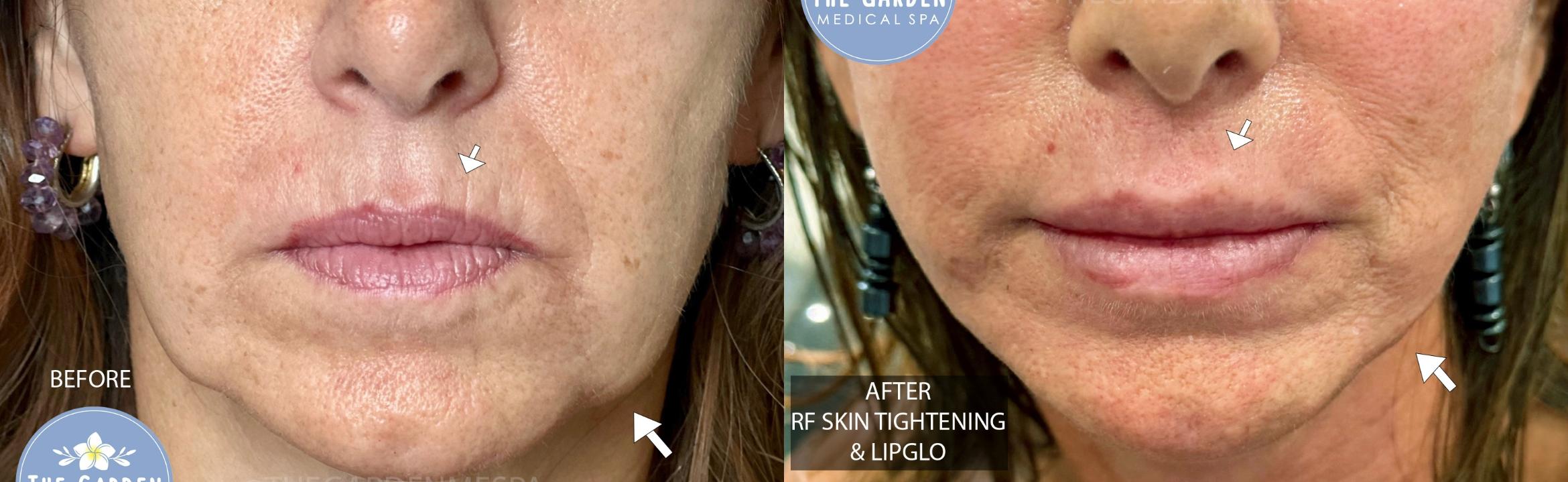 RF Skin Tightening & LipGlo