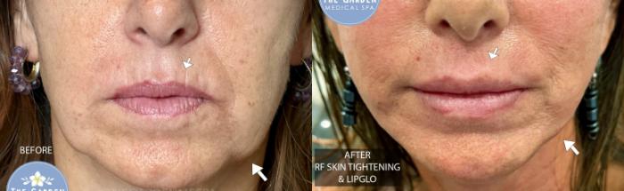 RF Skin Tightening & LipGlo