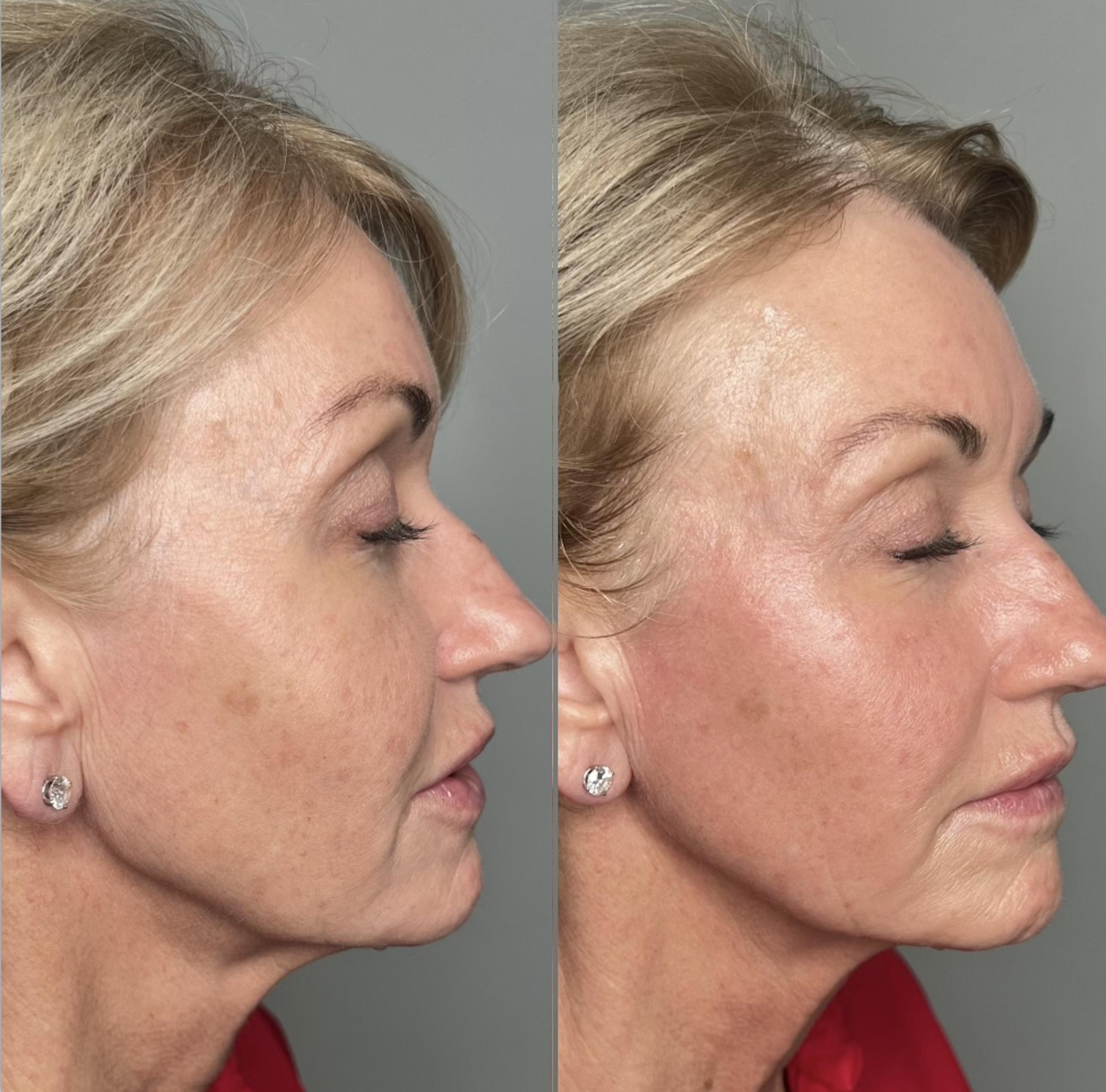 Before & After Radiofrequency Skin Tightening Client #68 Right Side View in Tampa Bay, North Palm Beach, FL