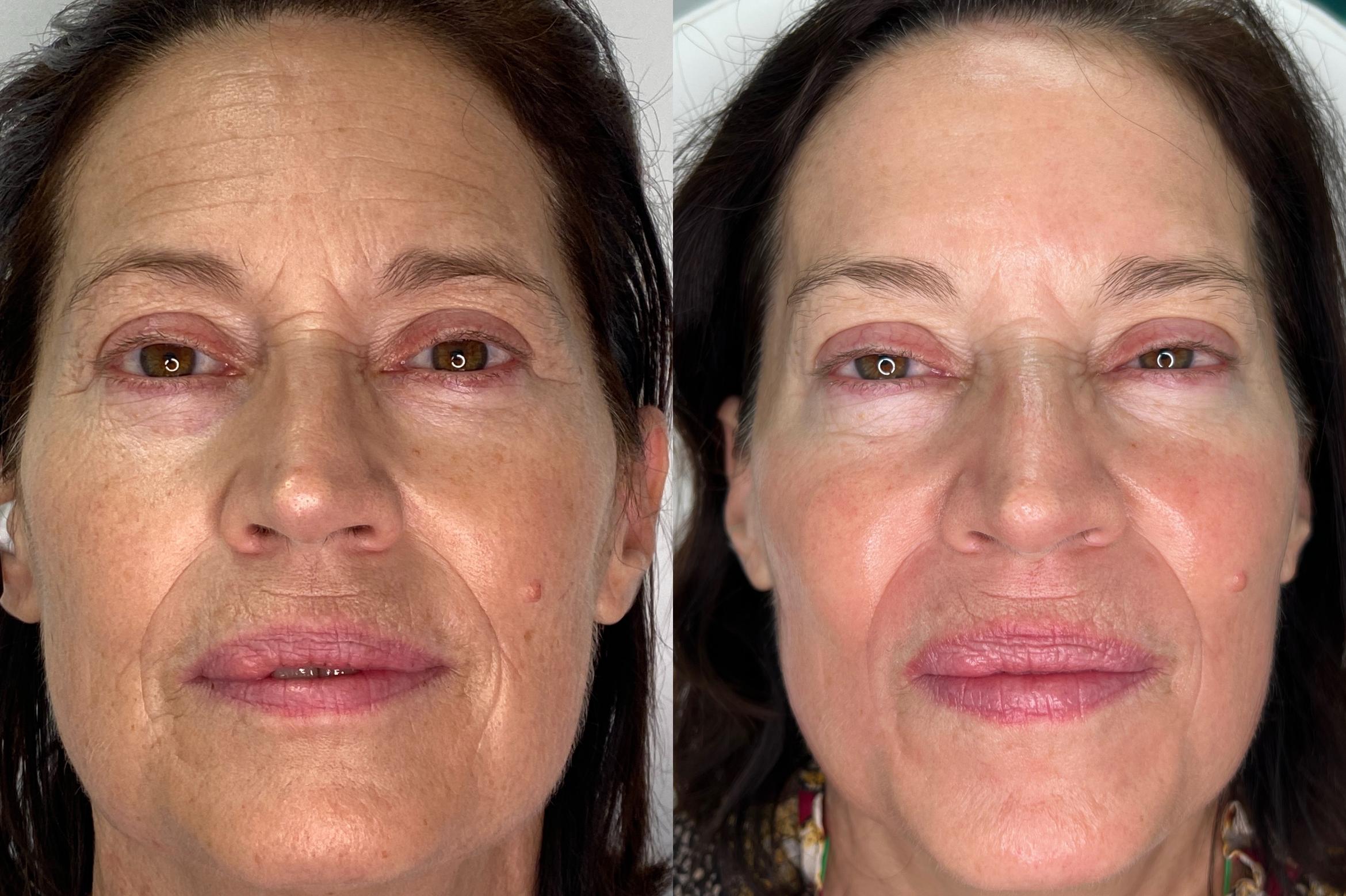 SmoothGlo & Botox