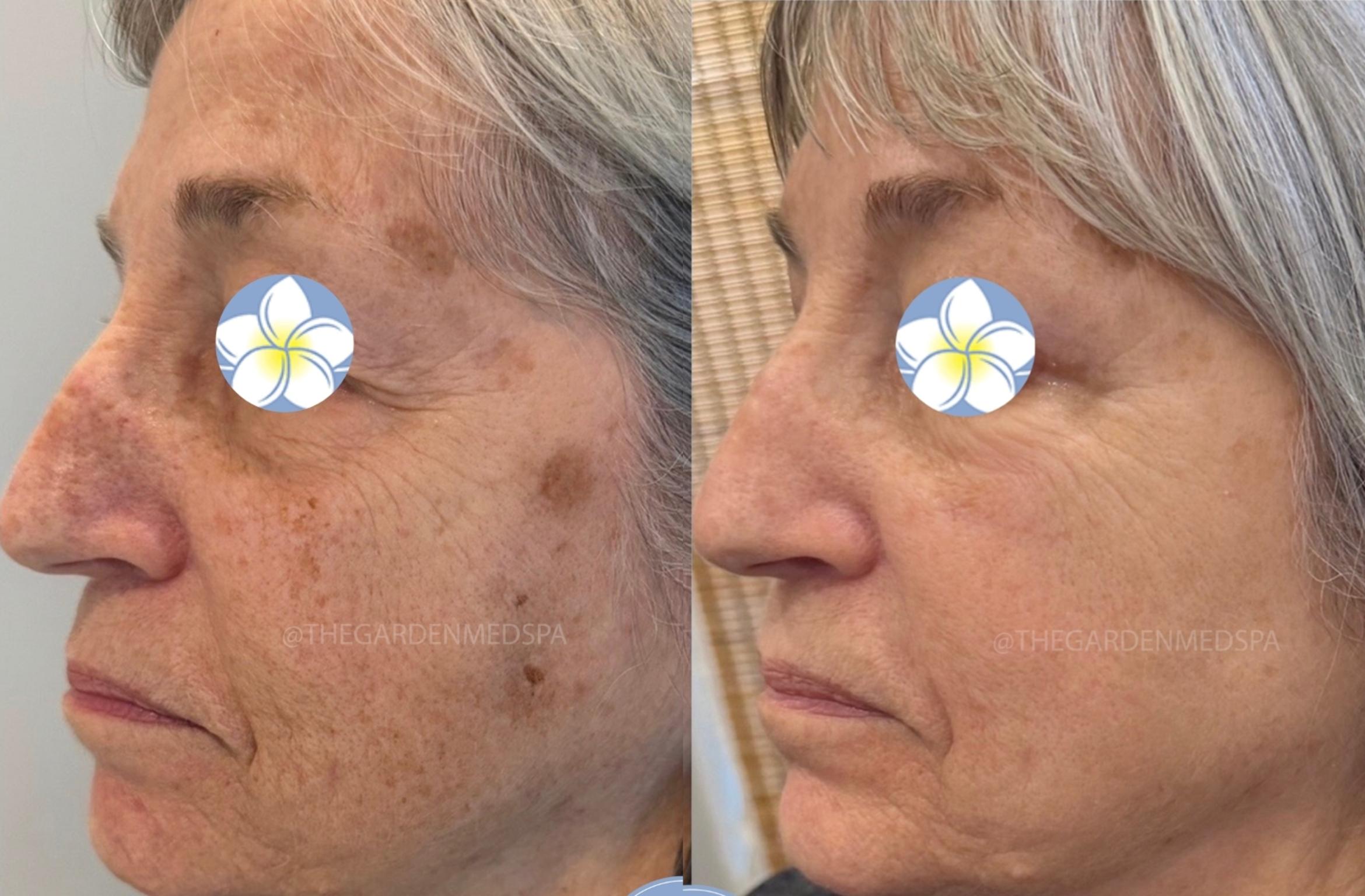 SmoothGlo After 1 Treatment