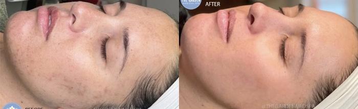 One Treatment Smoothglo