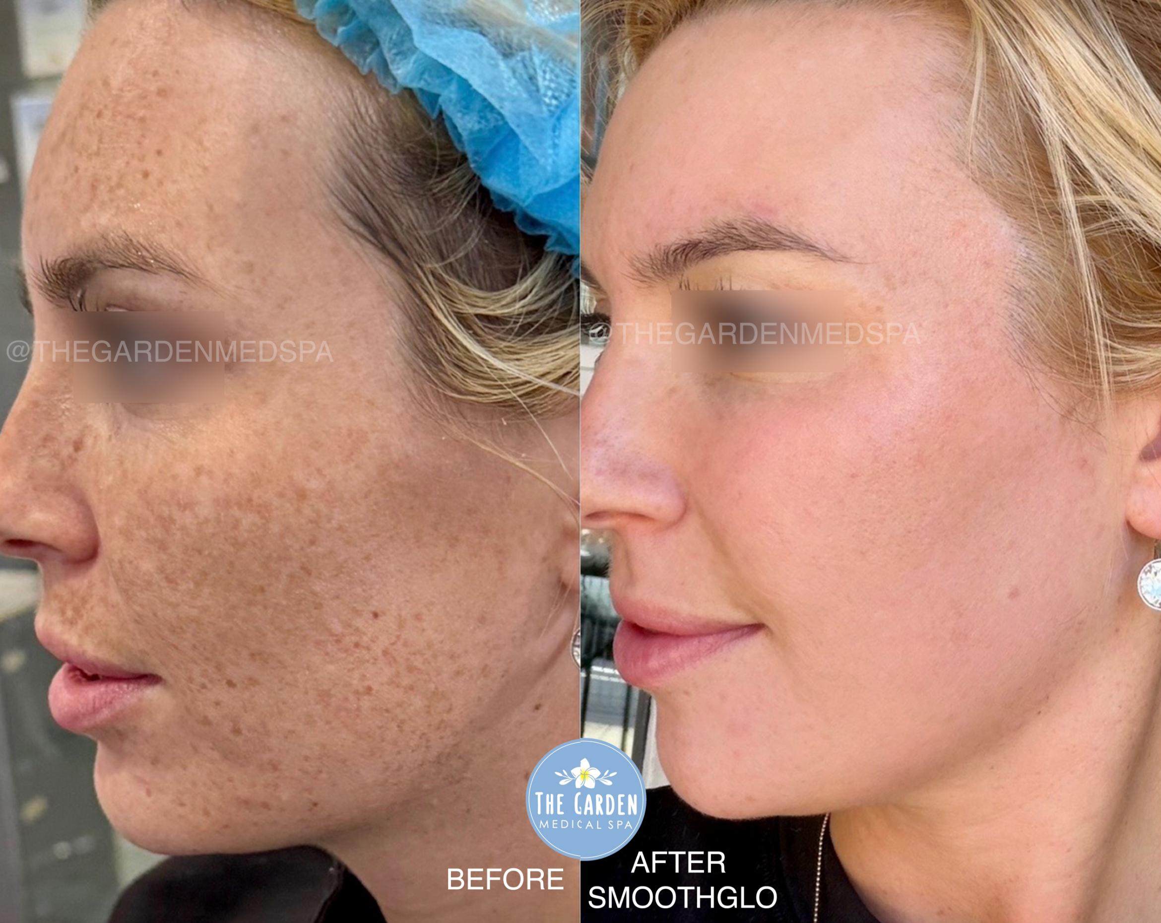 Before & After SmoothGlo™ Client #190 Left Side View in Pinellas Park, Clearwater, St. Petersburg, North Palm Beach