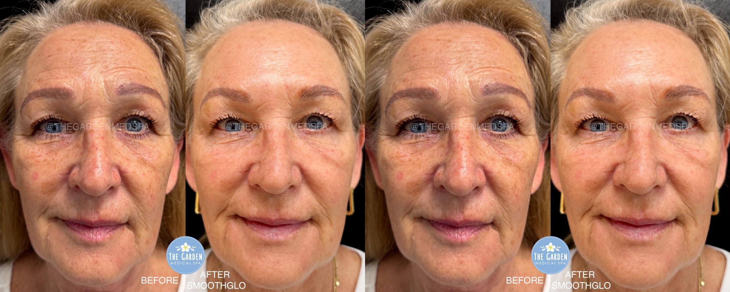 SmoothGlo for Texture and Tone