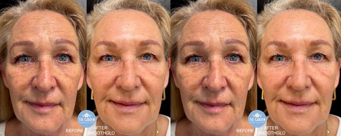 SmoothGlo for Texture and Tone