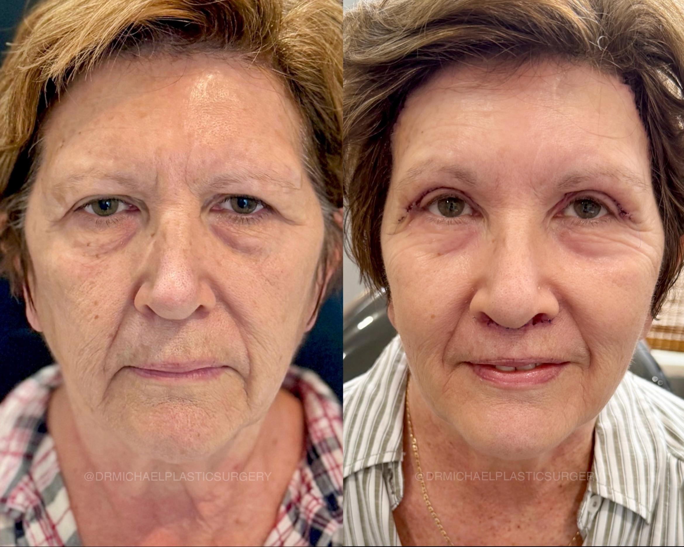SmoothGlo with Surgery Procedures