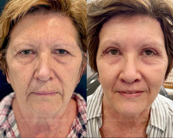 SmoothGlo with Surgery Procedures