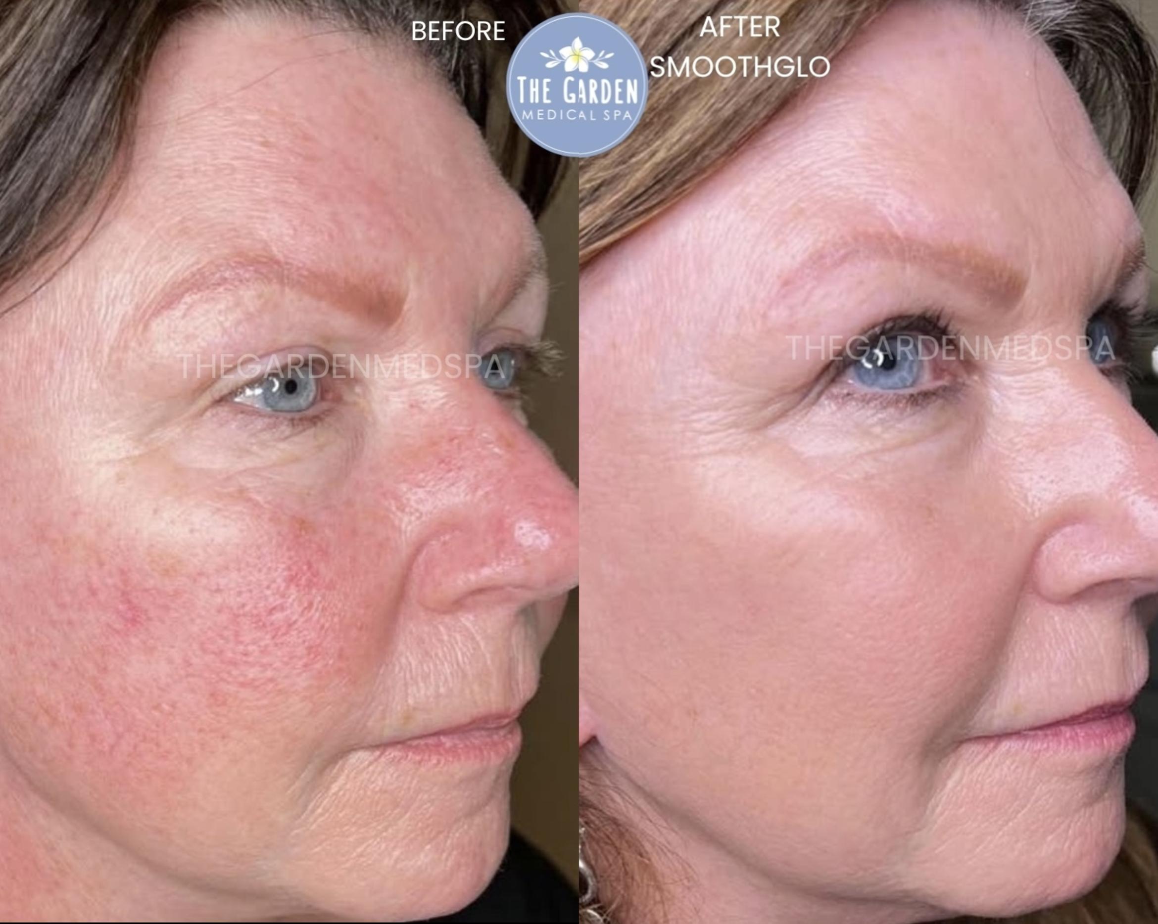 SmoothGlo for Rosacea
