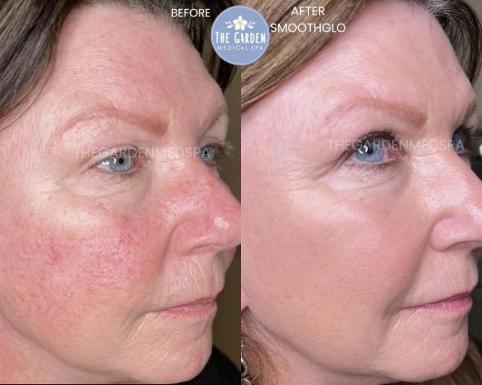 SmoothGlo for Rosacea