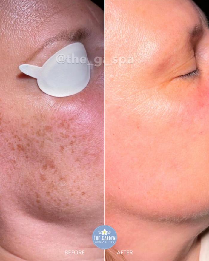 SmoothGlo One Treatment 