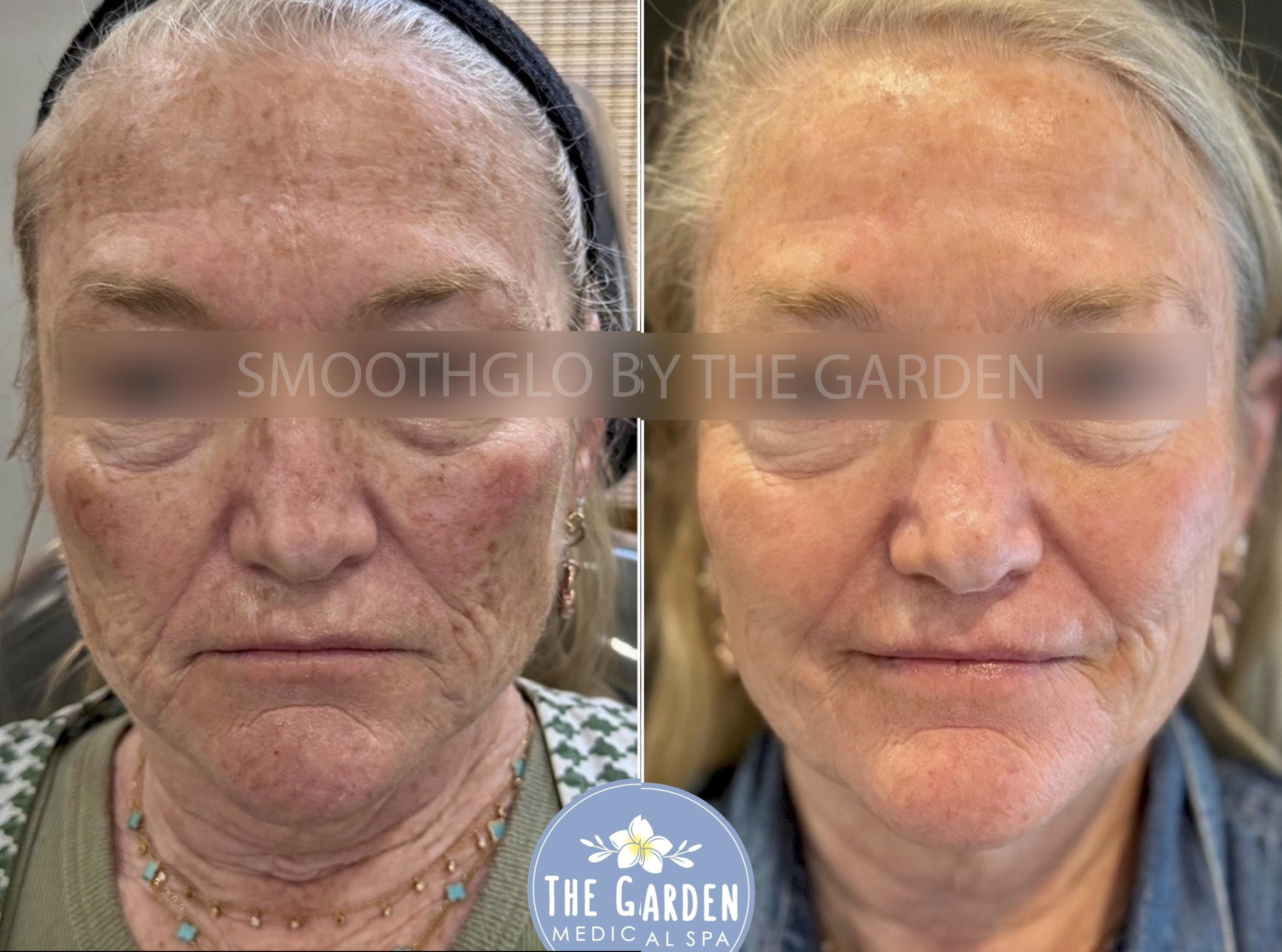 SmoothGlo for Freckles & Sun Damage
