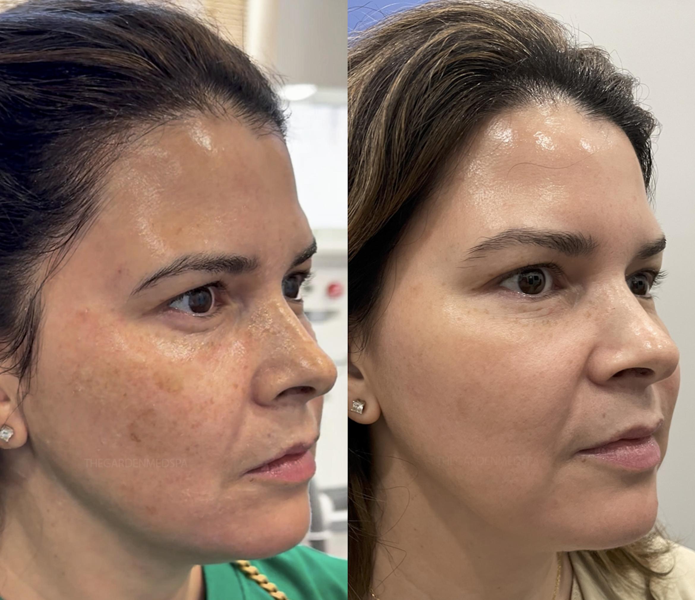 Before & After SmoothGlo™ Client #219 Right Side View in Pinellas Park, Clearwater, St. Petersburg, North Palm Beach