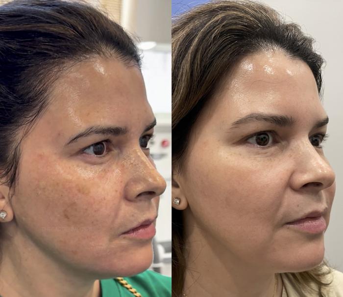 Before & After SmoothGlo™ Client #219 Right Side View in Pinellas Park, Clearwater, St. Petersburg, North Palm Beach