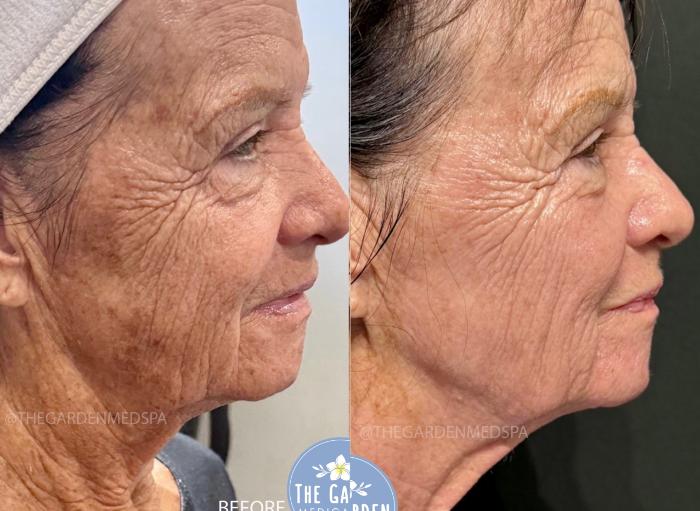 SmoothGlo for Severe Sun Damage