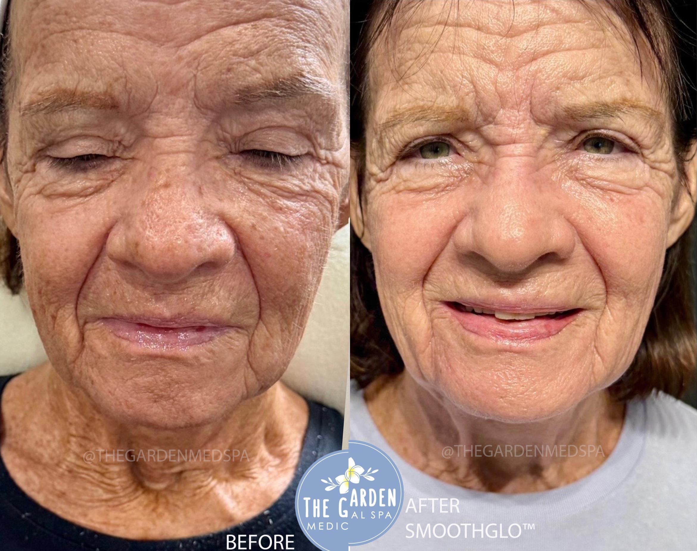 SmoothGlo for Severe Sun Damage
