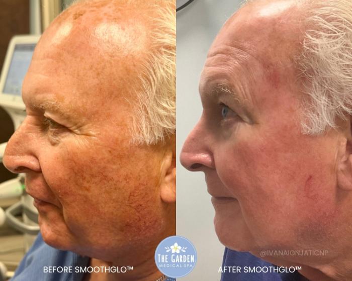 SmoothGlo for Blood Vessels