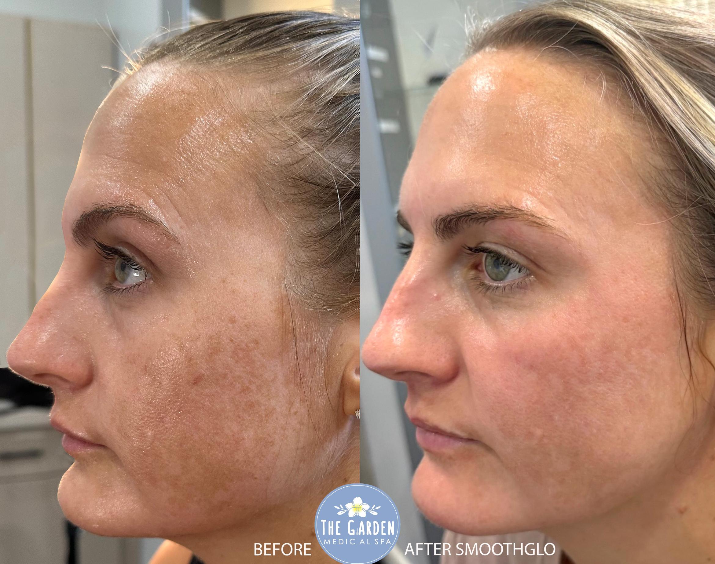 SmoothGlo for Visible Sun Damage