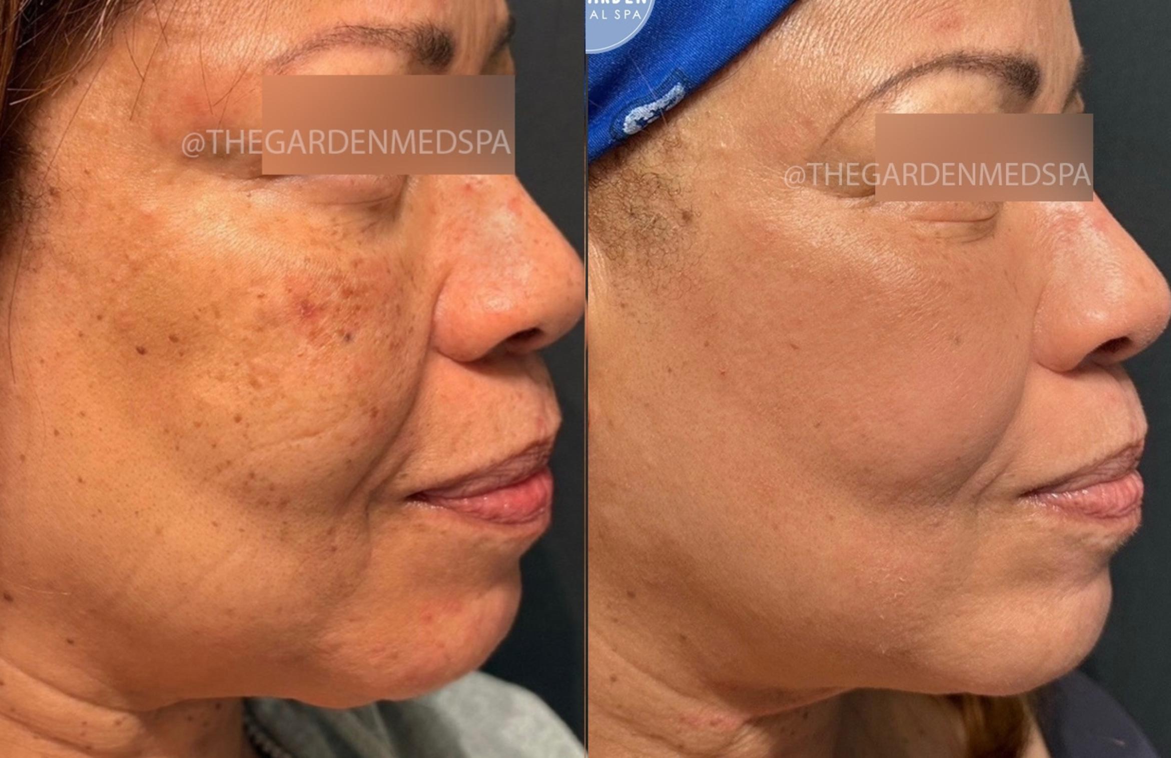 One Treatment SmoothGlo