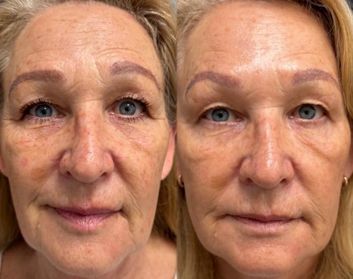 SmoothGlo for Sun Damage