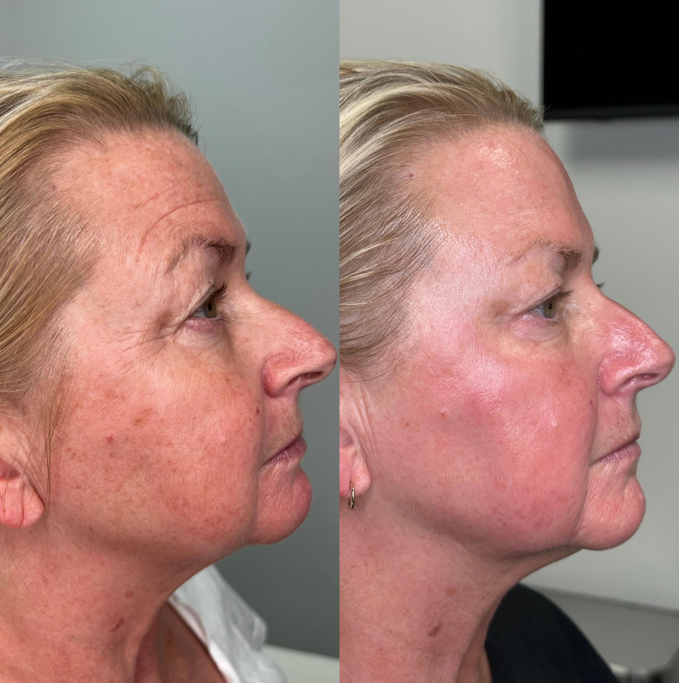 Before & After SmoothGlo™ Client #26 Right Side View in Tampa Bay, North Palm Beach, FL