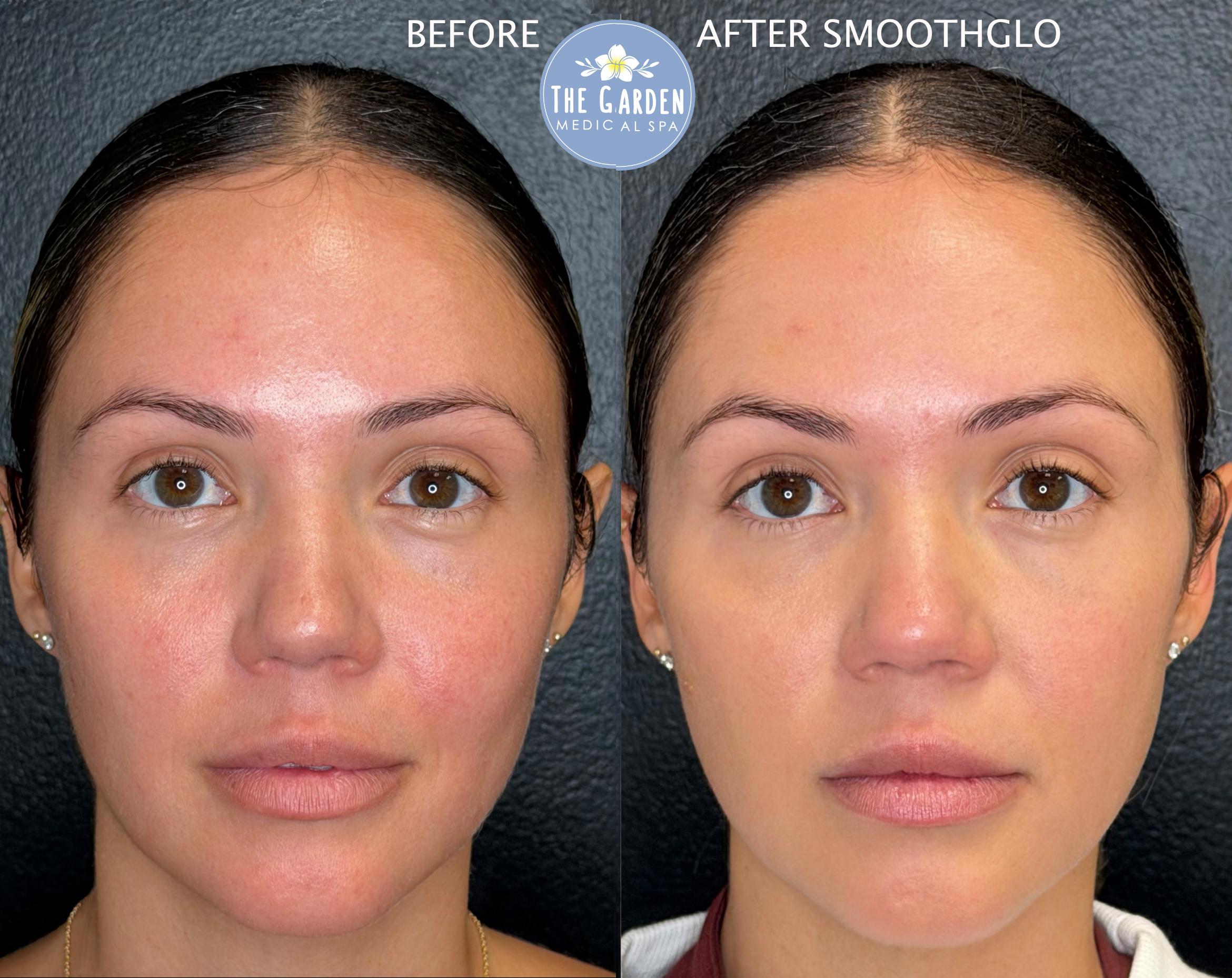 SmoothGlo for Rosacea