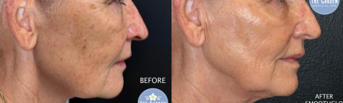  2 SmoothGlo Results