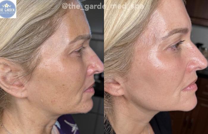 Before & After SmoothGlo™ Client #27 Right Side View in Tampa Bay, North Palm Beach, FL