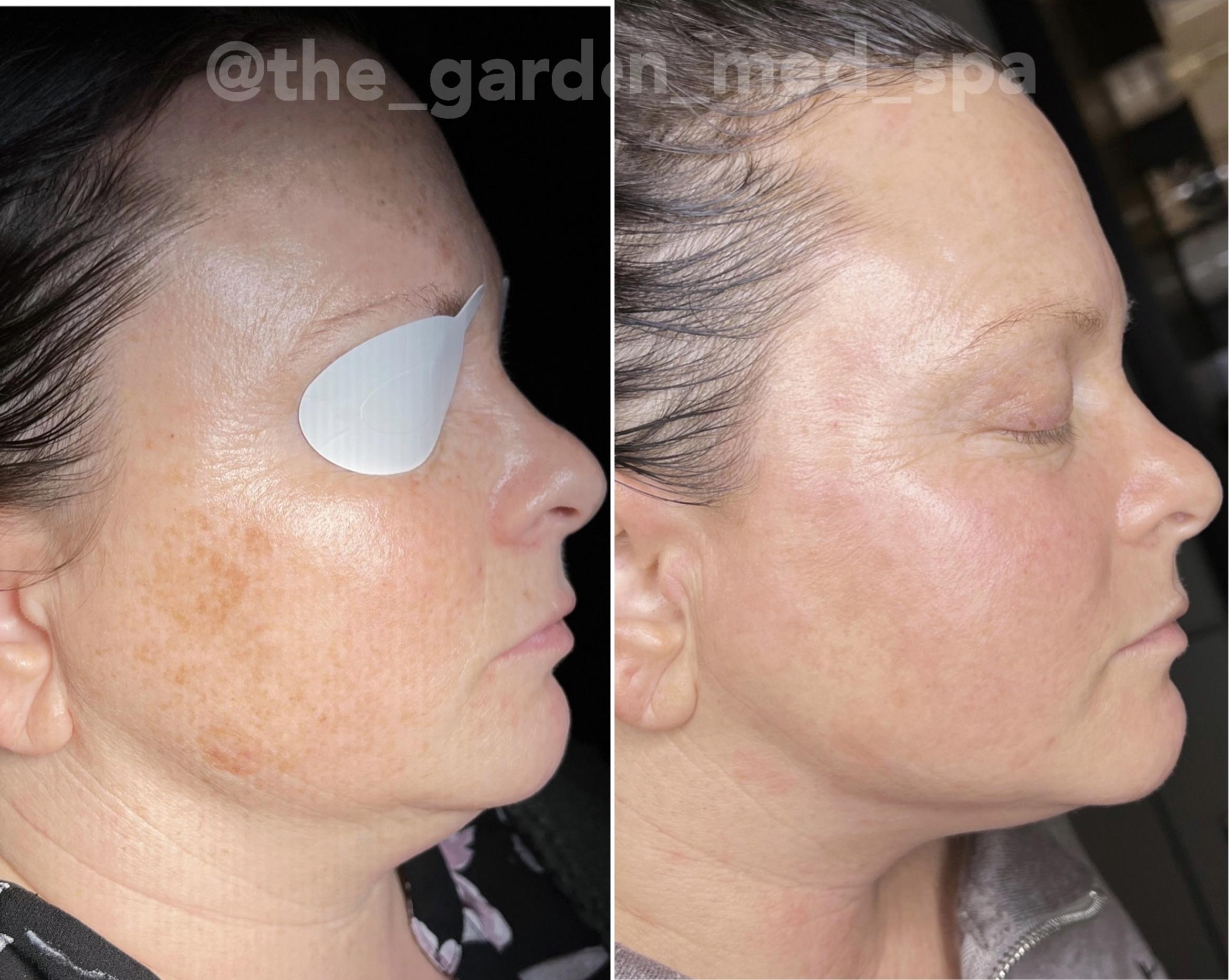 Before & After SmoothGlo™ Client #33 Right Side View in Tampa Bay, North Palm Beach, FL