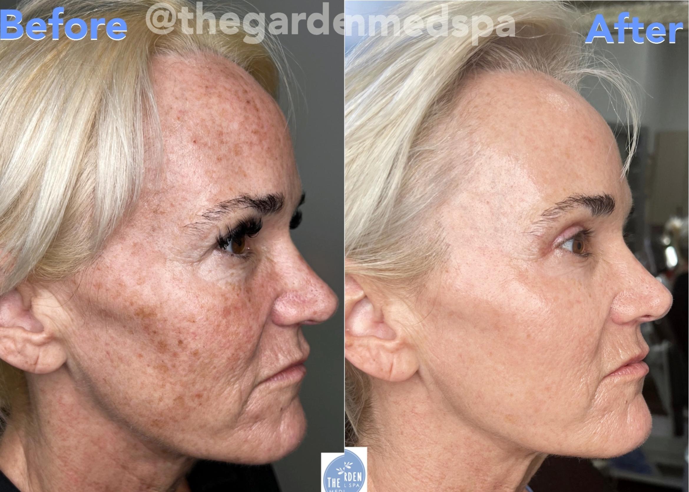 Before & After SmoothGlo™ Client #46 Right Side View in Tampa Bay, North Palm Beach, FL