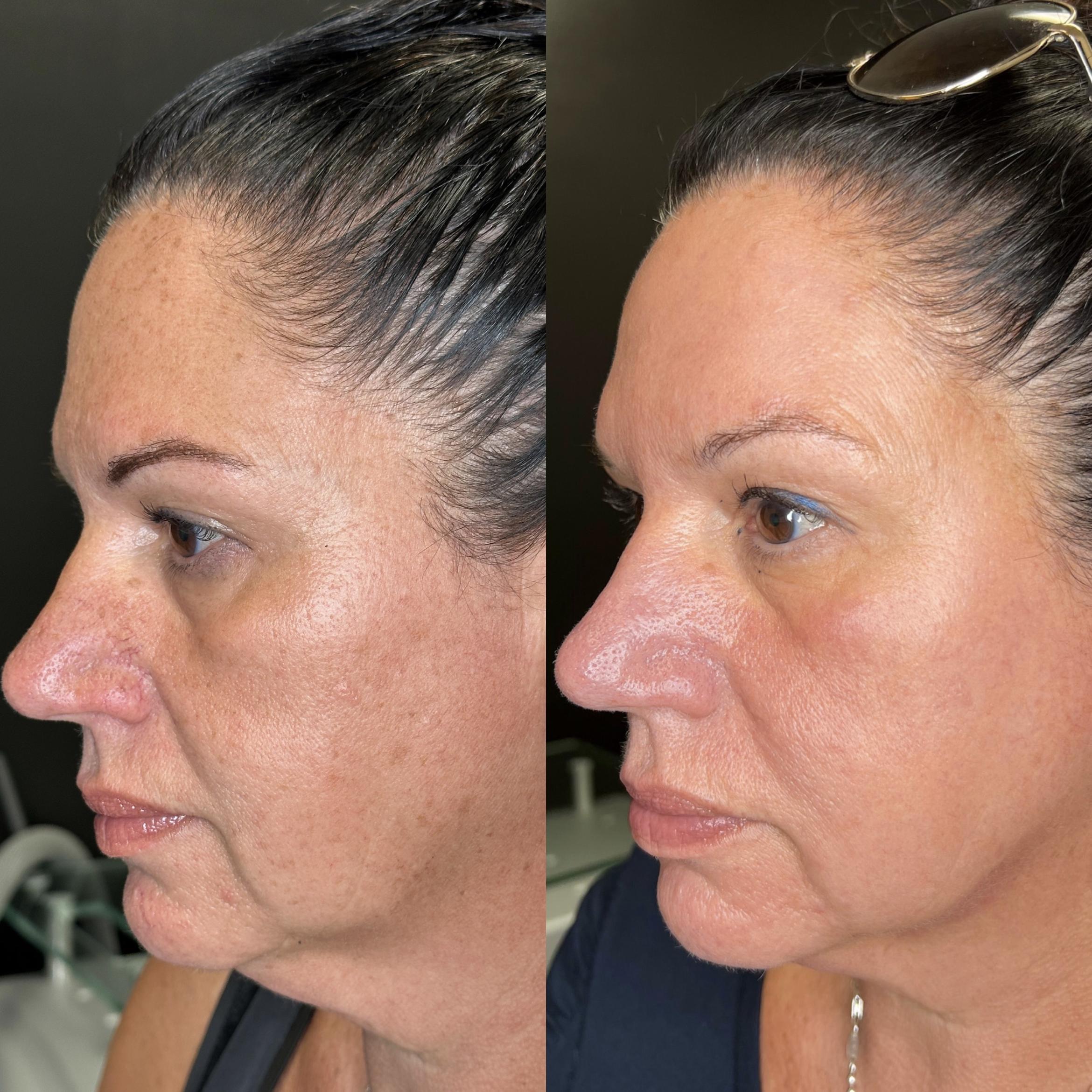 Before & After SmoothGlo™ Client #50 Left Side View in Tampa Bay, North Palm Beach, FL