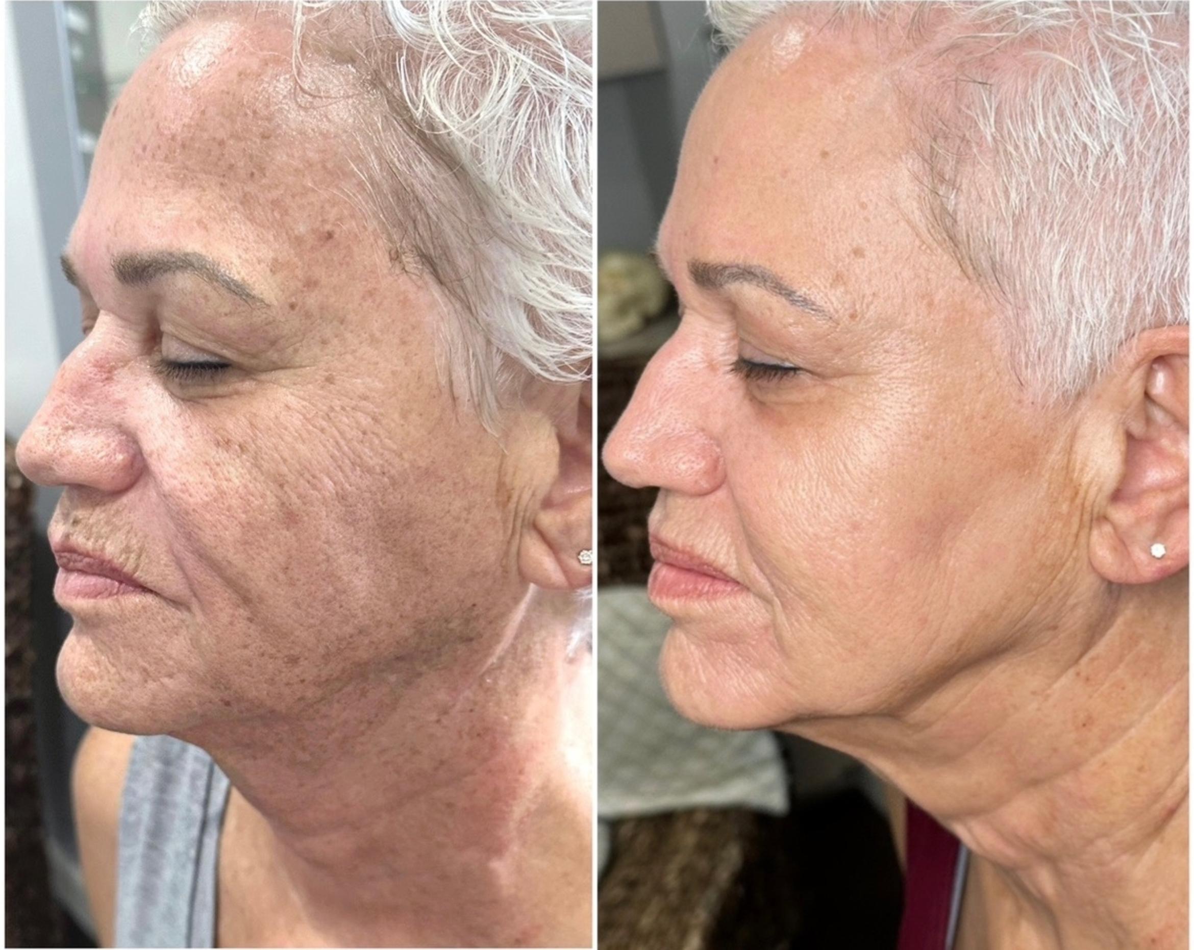 Before & After SmoothGlo™ Client #53 Left Side View in Tampa Bay, North Palm Beach, FL