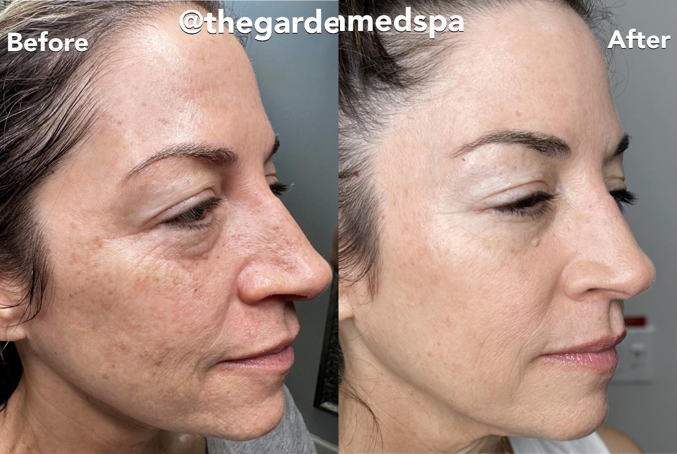 Before & After SmoothGlo™ Client #63 Right Side View in Tampa Bay, North Palm Beach, FL