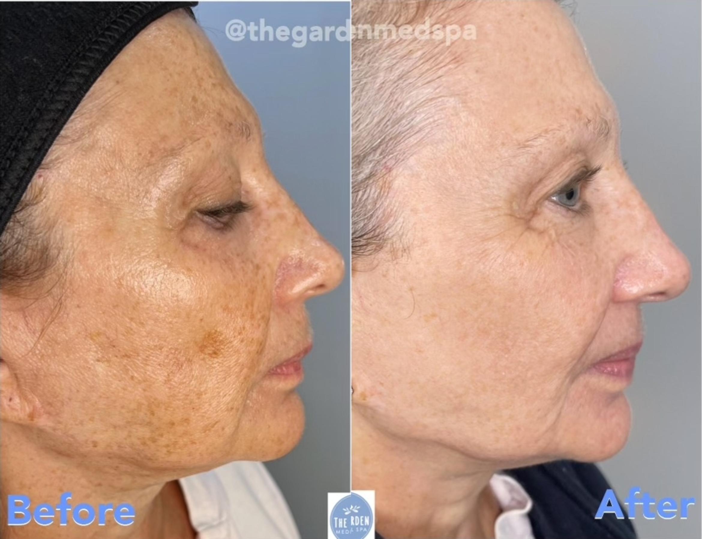 Before & After SmoothGlo™ Client #65 Right Side View in Pinellas Park, Clearwater, St. Petersburg, North Palm Beach