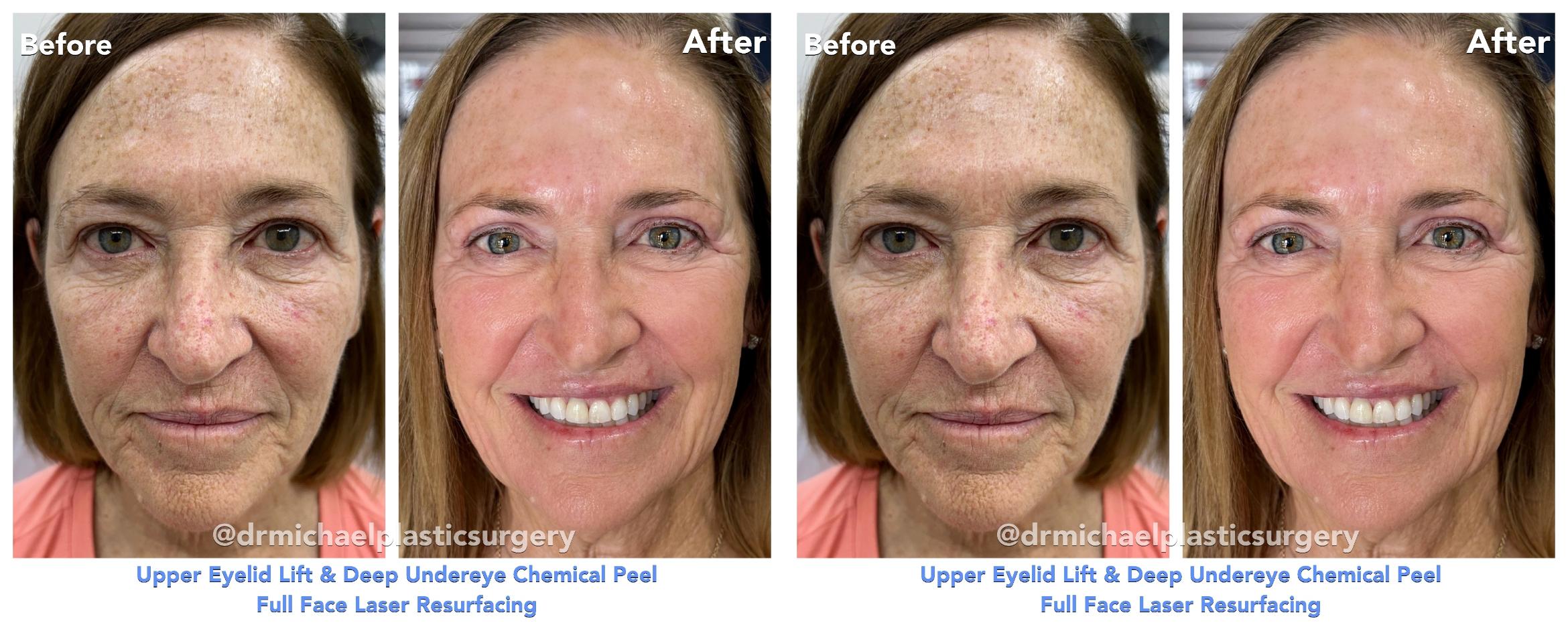 SmoothTone with Upper Bleph & Chemical Peel