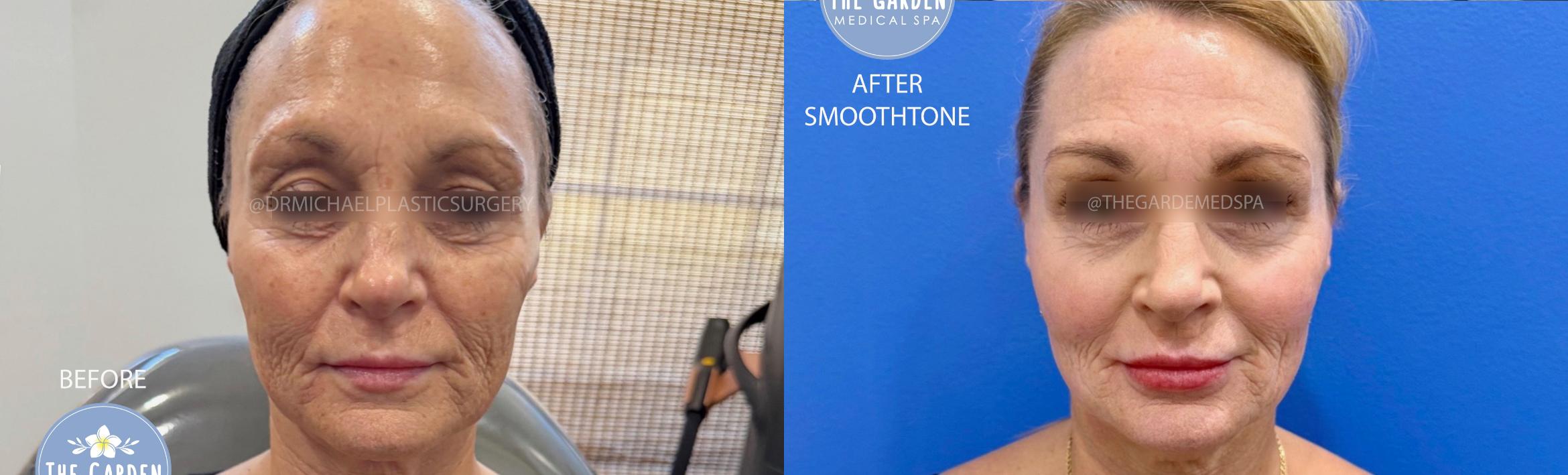 SmoothTone